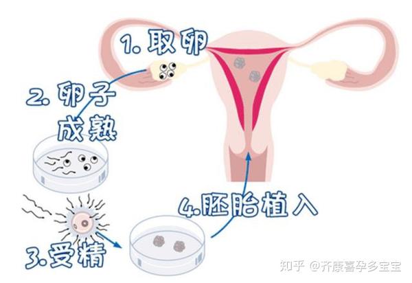 取卵过程解析，卵泡扎破是真相吗？